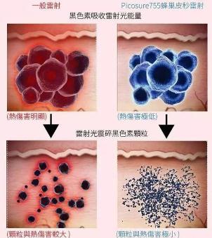 做激光祛斑手术的时候，为什么会有一股烧焦的味道？