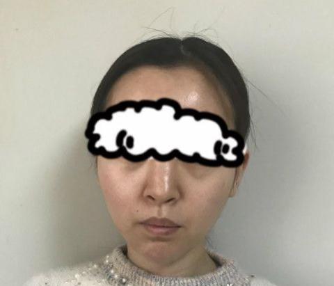 北京假体隆鼻修复案例，术后日记分享！