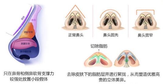 鼻翼缩小手术过程