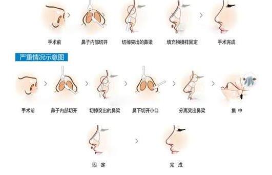 驼峰鼻手术调节价钱花费详解