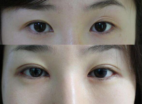 双眼皮手术案例图