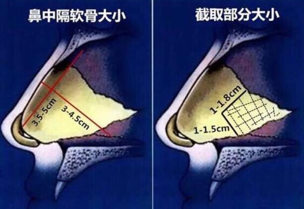 鼻中隔软骨可以直接从原来的切口取出