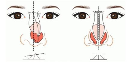 假体隆鼻失败修复手术有哪些方法？