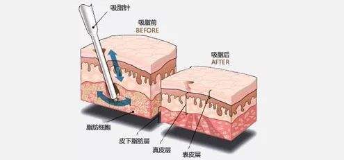 吸脂注意事项——这些事情做好，果事半功倍