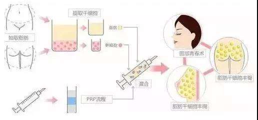 鼻唇沟填充能维持多久？可以选择哪些材料？