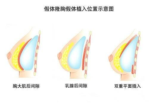 怕疼的人想问问没多少痛感隆胸这种方法有没有？