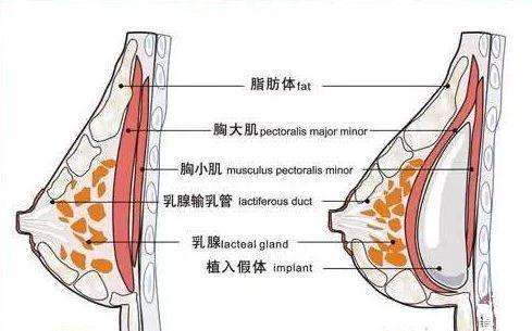 怕疼的人想问问没多少痛感隆胸这种方法有没有？