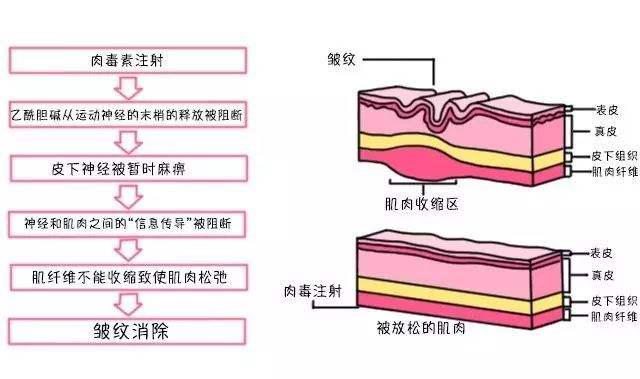 面部除皱采用玻尿酸和注射瘦脸，两者的不同之处