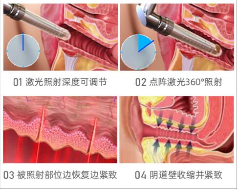 徐州阴道缩紧手术需要多少钱?