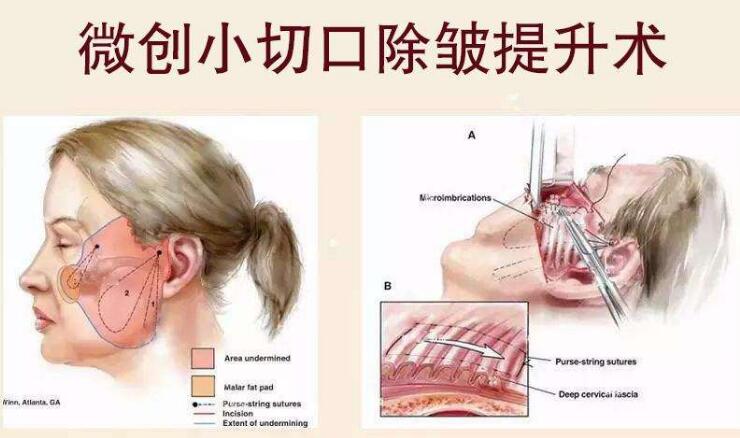 拉皮的副作用