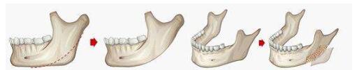 下颌角接骨整形