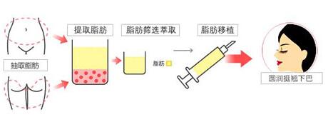 整形垫下巴做的好