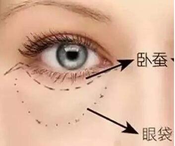 北京叶美人整形医院吸脂去眼袋都有哪些优点呢 重现眼部光彩