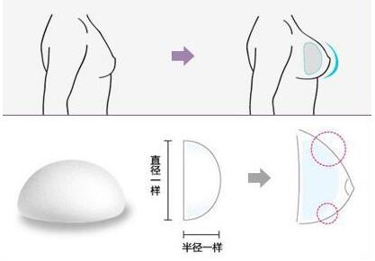 这样子做隆胸手术