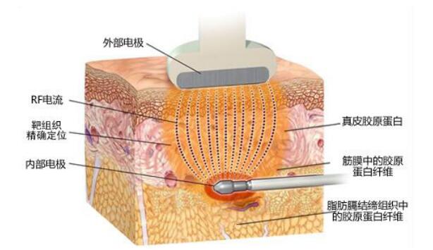 科普：医美中各种各样的减肥方法看看哪一种适合自己