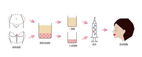 做自体脂肪隆鼻可能会变宽吗?危害什么