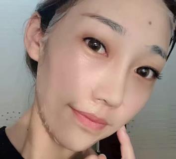 广州美莱陈贵宗割双眼皮好吗?医生简介+前后对照图片