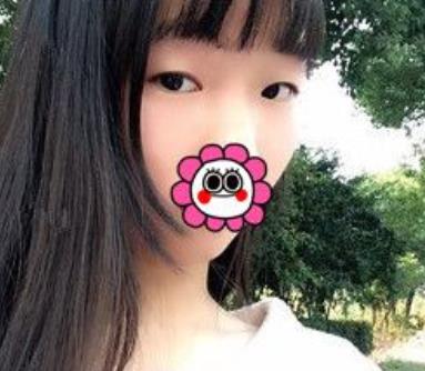 沈阳杏林张莹莹双眼皮案例？看医生简介和技术如何