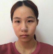 四川华美紫馨医学美容热玛吉怎么样？可查真人案例及授权认证书哦~