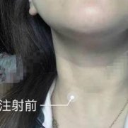 长春东方医疗美容去颈纹怎么样？手术价格【案例】在线参考