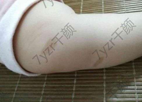 激光去胎记会影响健康吗？孩子年纪太小能不能做？